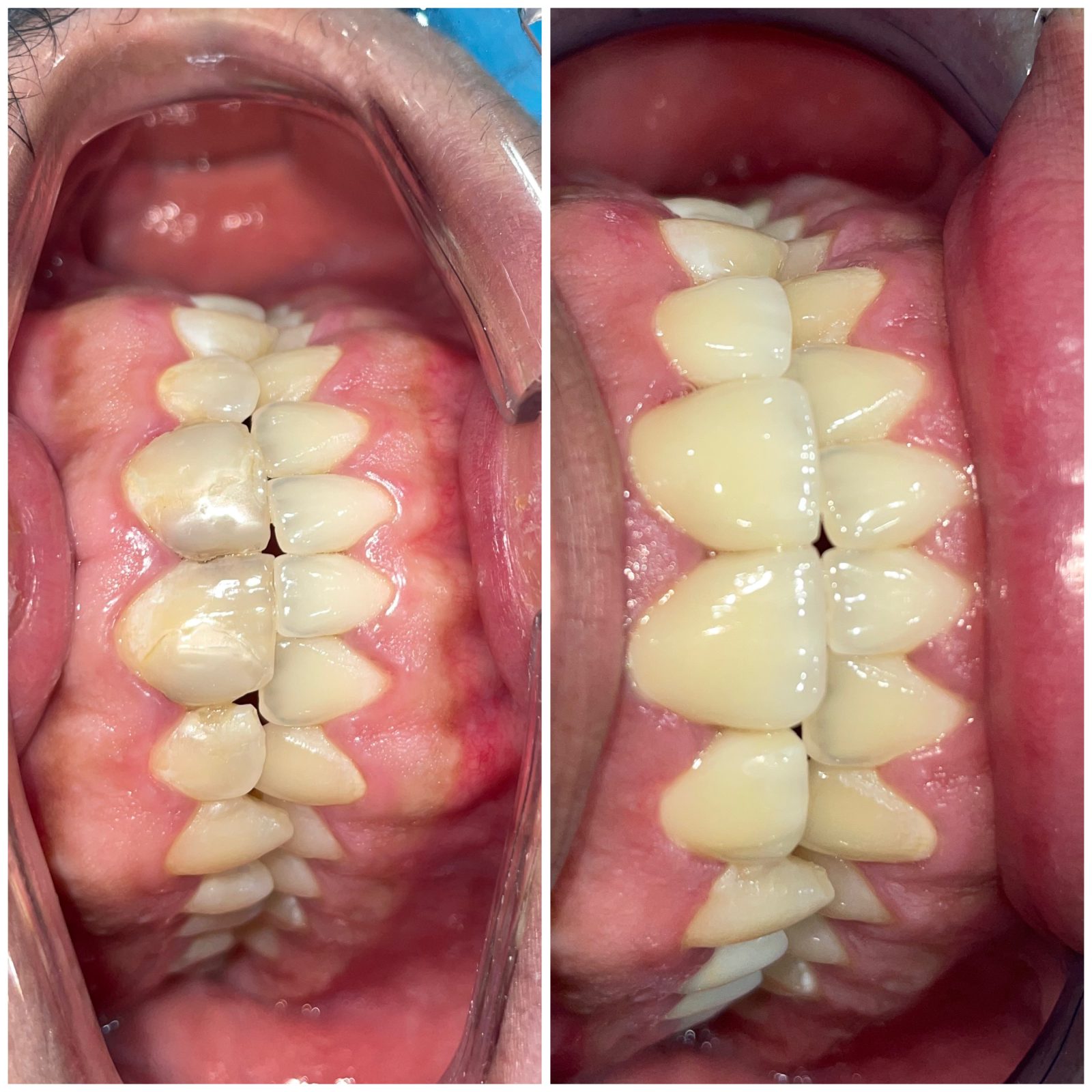Anterior Veneer Rehabilitation